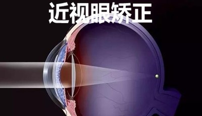 近视眼矫正加盟